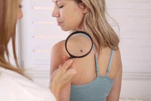 What Are Traditional Skin Lesion Removal Methods Cheshunt?