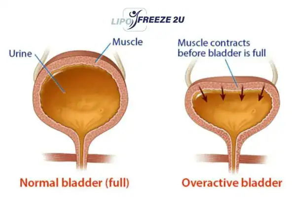 diagram of overactive bladder treatment Cheshunt
