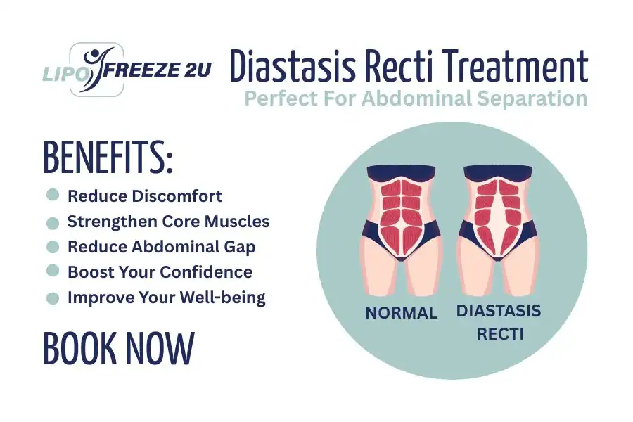 Benefits of body toning treatment Cheshunt for Diastasis recti