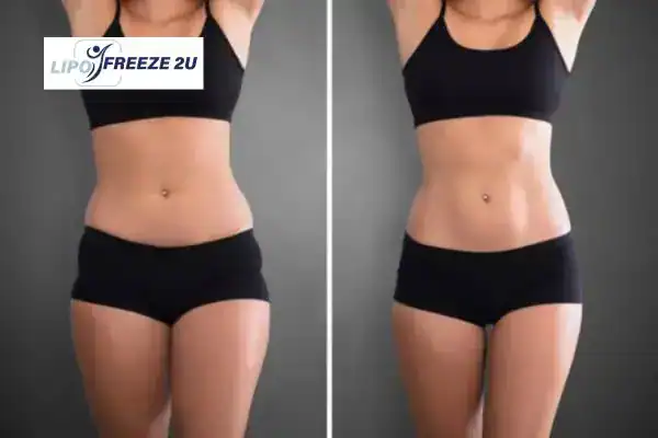 How Can LIPO FREEZE 2U Support Your Post-Pregnancy Body Recovery Cheshunt?