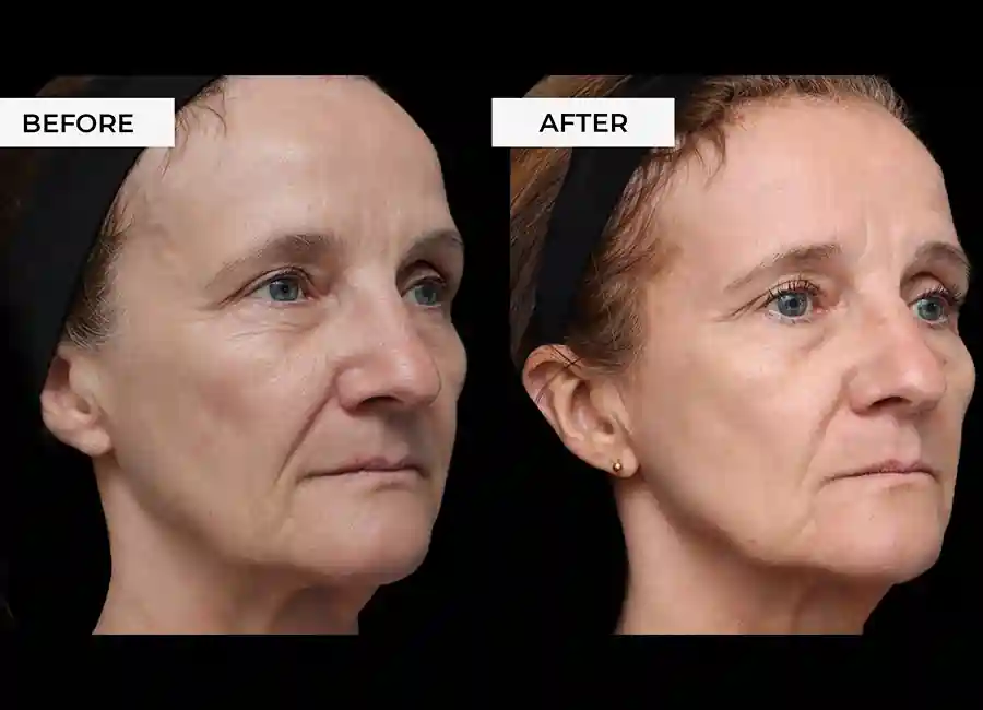 How Many RF Microneedling Sessions Will You Need to See a Difference Cheshunt?