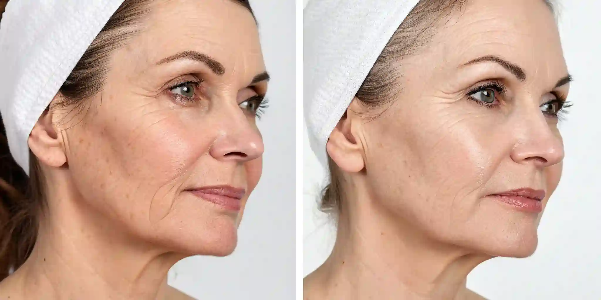 Common Questions About RF Microneedling and Loose Skin Cheshunt