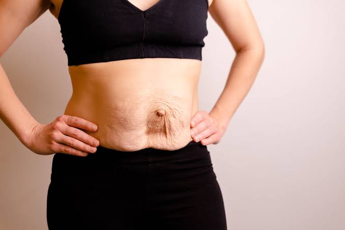 Is Surgery Really the Only Way to Repair Diastasis Recti Cheshunt?