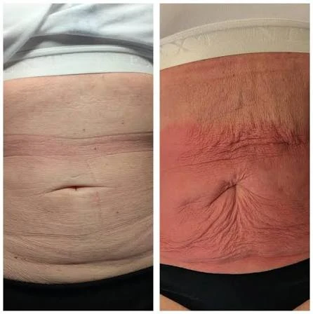 How Does RF Microneedling Improve Crepey, Thin and Uneven Skin Texture Cheshunt?