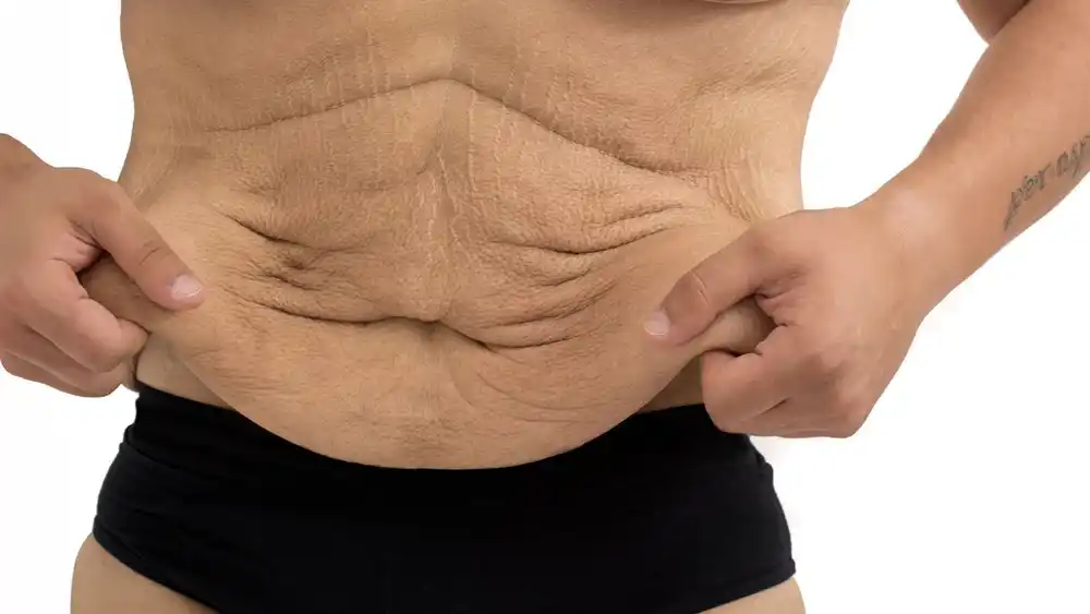 Why Does Weight Loss Medication Leave Some People With Loose or Sagging Skin Cheshunt?
